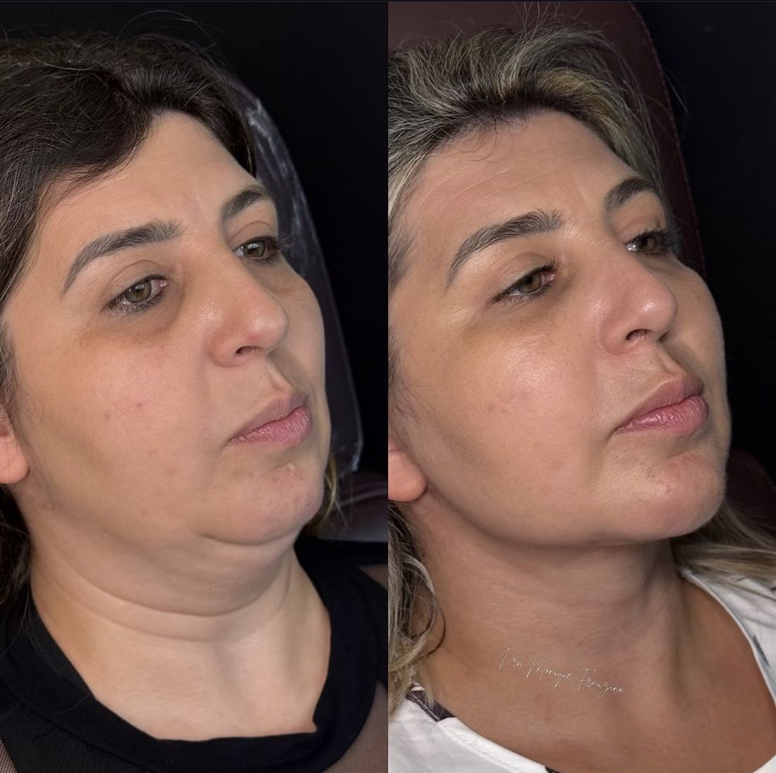 Antes e depois Lipo de Papada