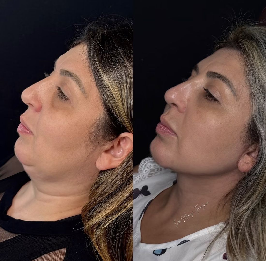 Antes e depois Lipo de Papada