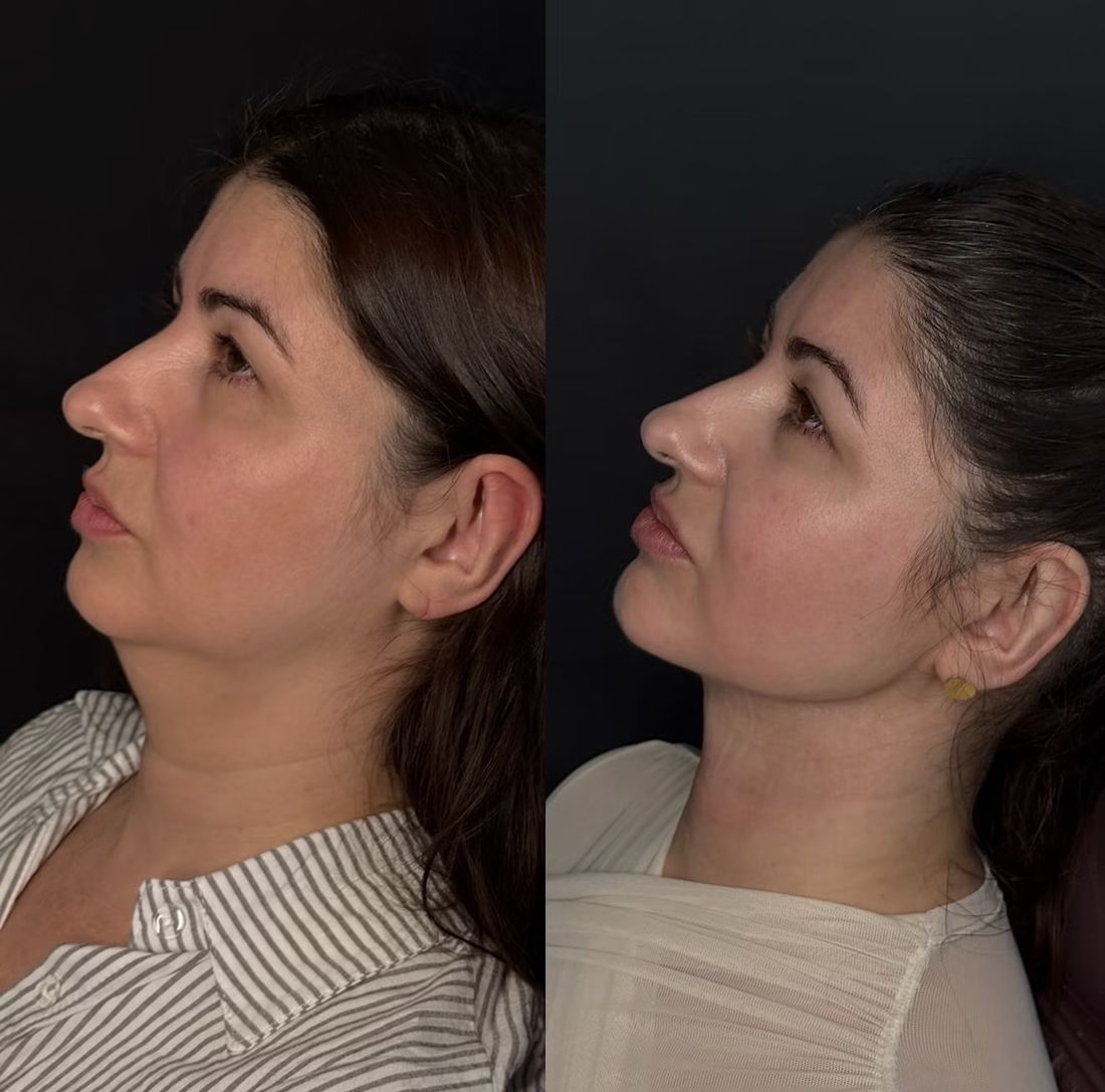 Antes e depois Lipo de Papada
