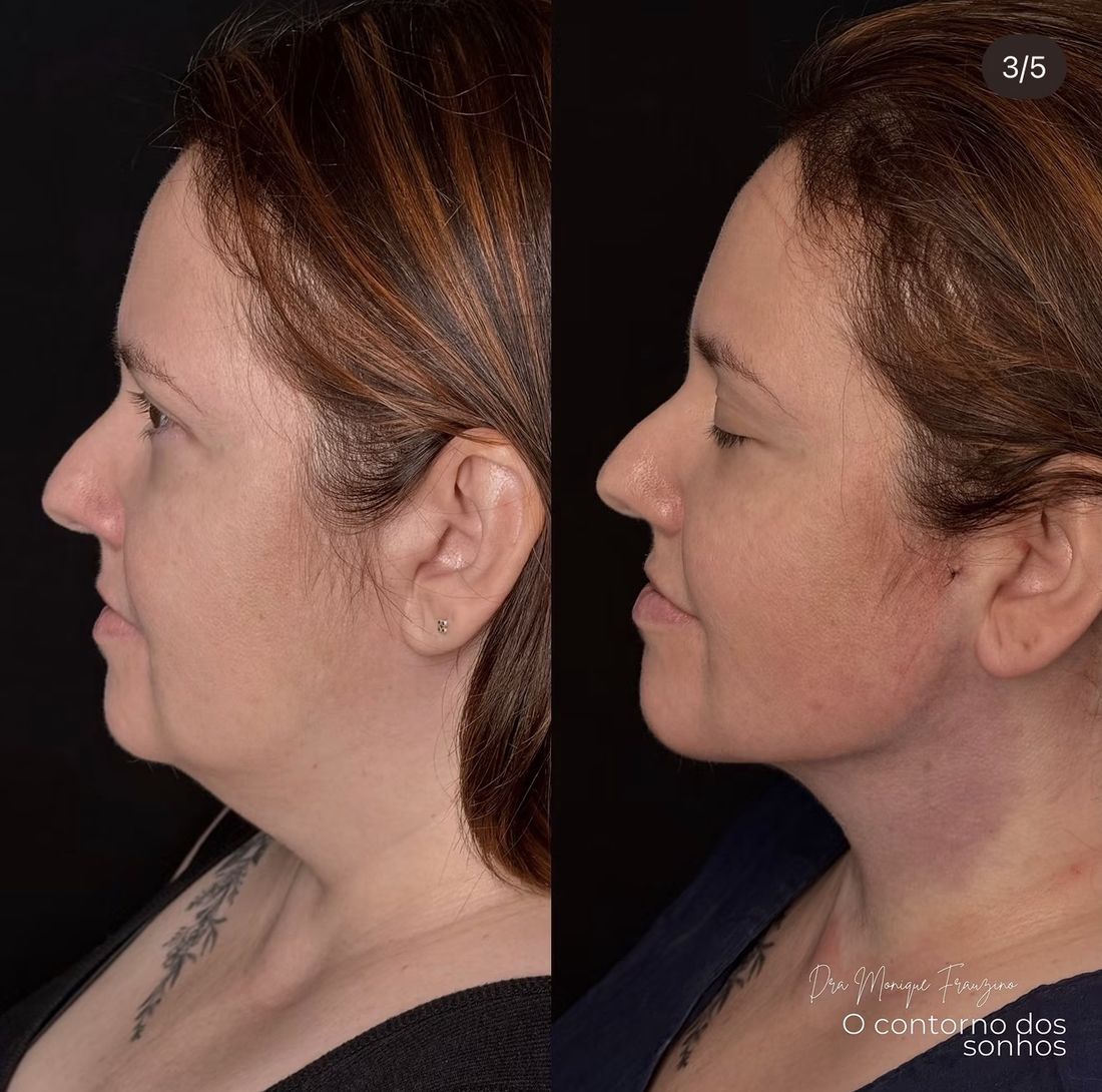 Antes e depois Lipo de Papada