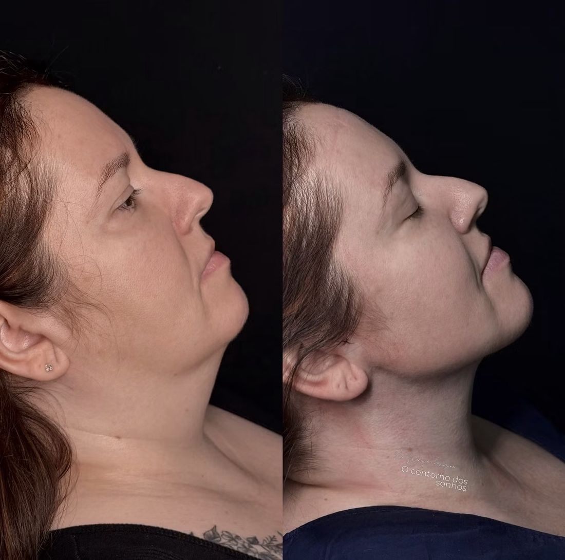 Antes e depois Lipo de Papada