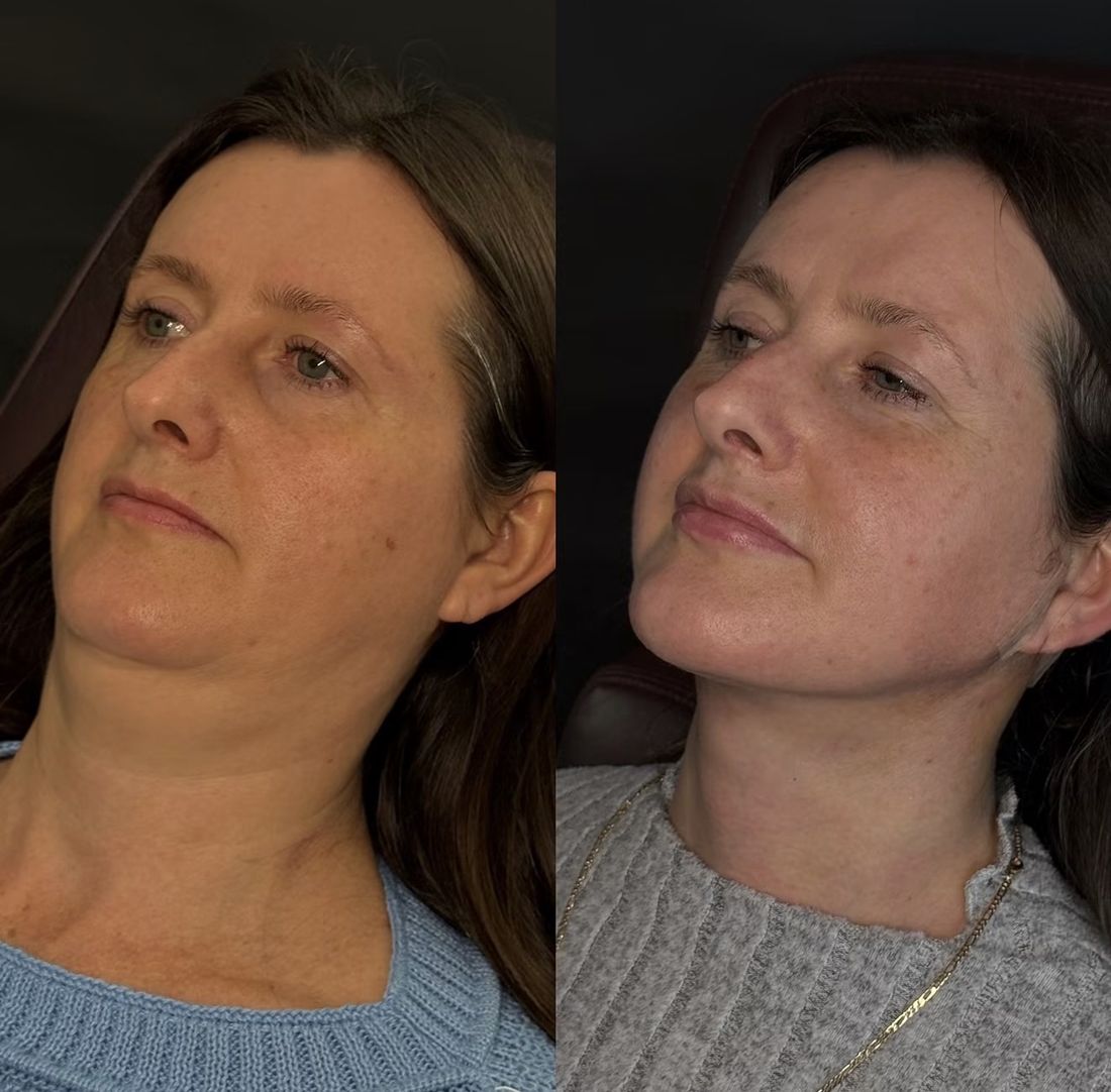 Antes e depois rosto e pescoço