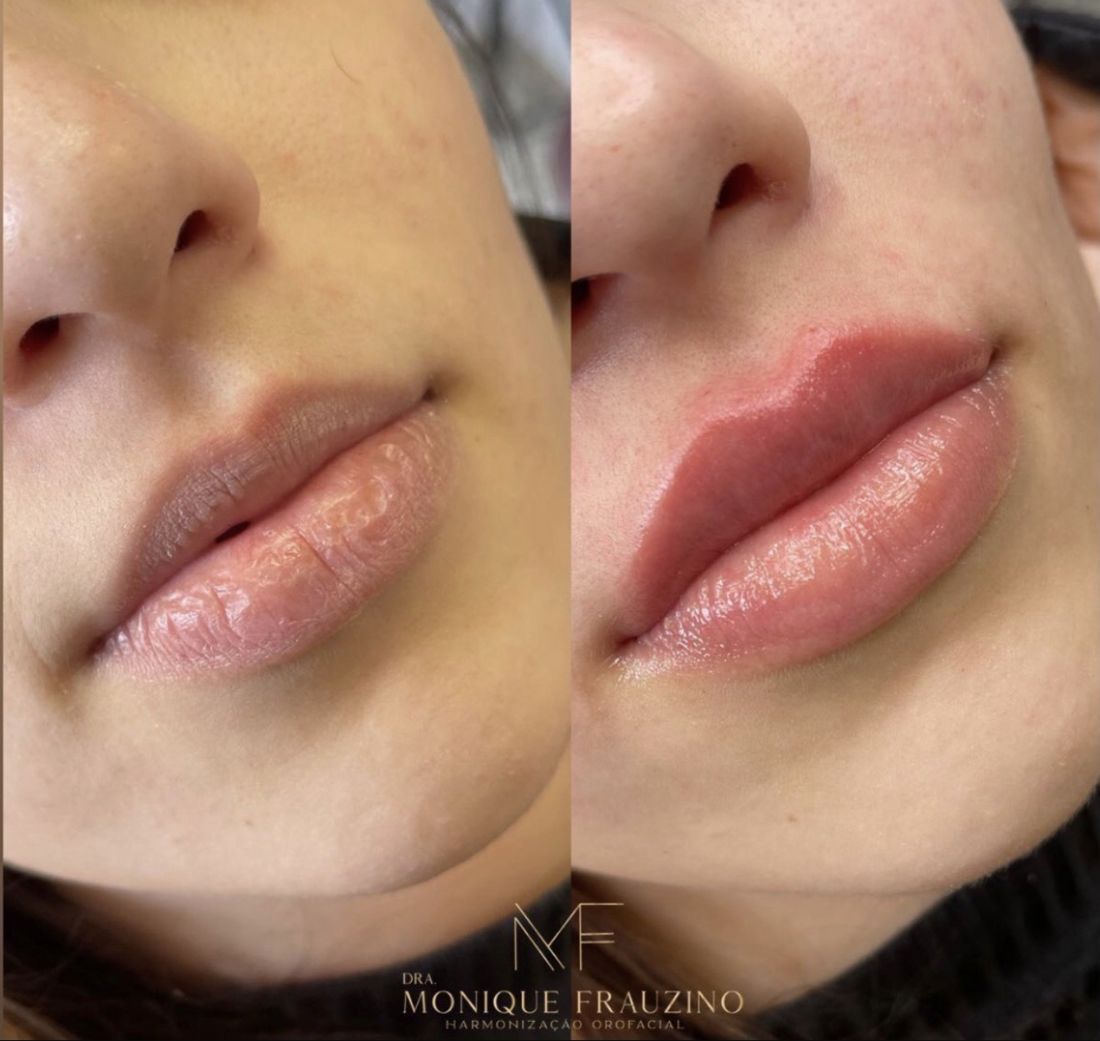 Antes e depois de preenchimento labial da Dra. Monique