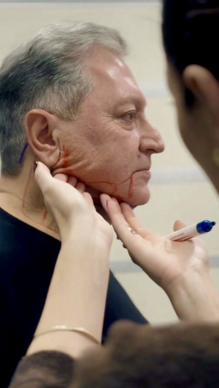 Marcação para Lipo de Papada HD